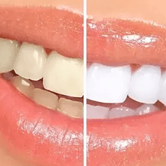 Bleaching and Tooth Whitening